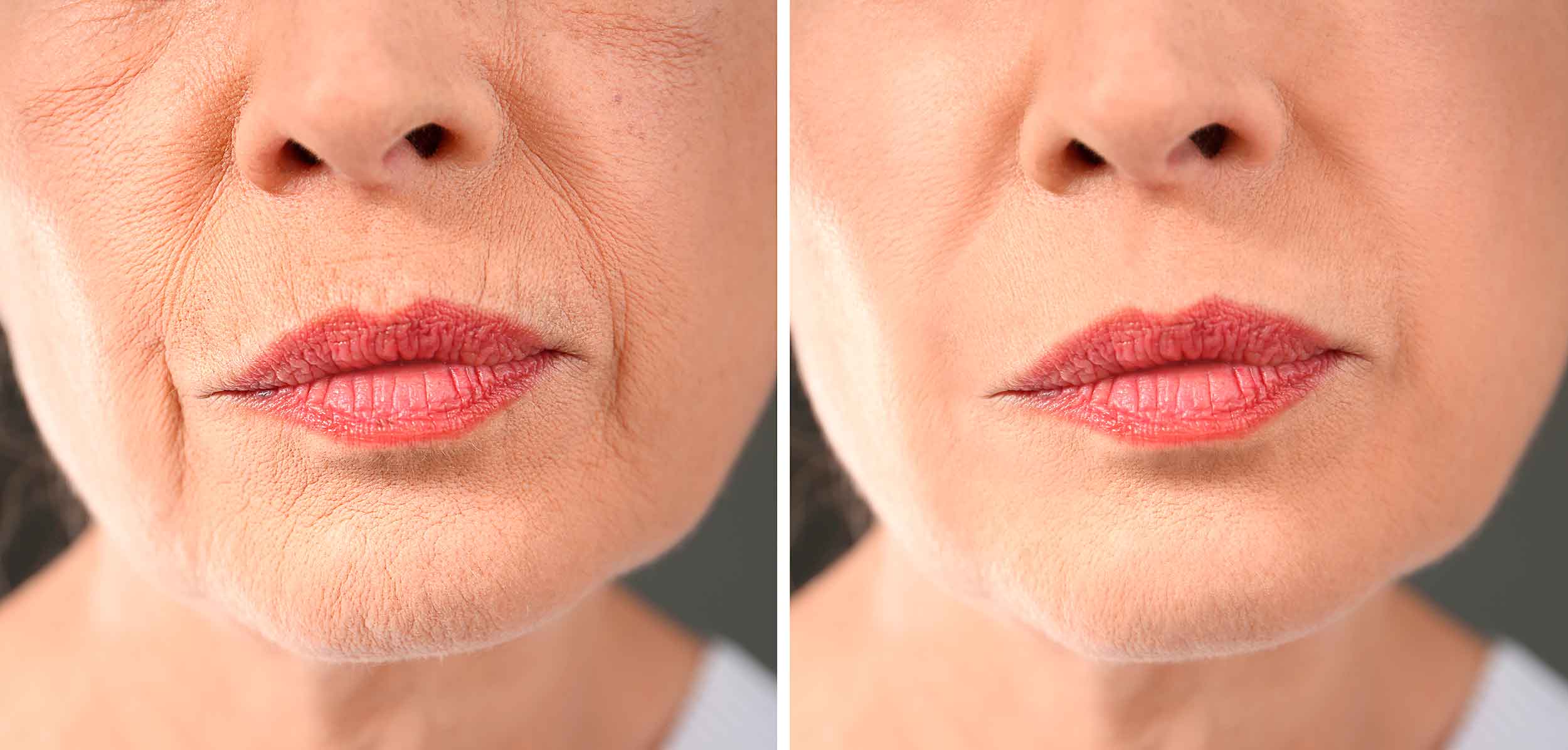 Cómo las imágenes de Antes y Después pueden ayudarte a captar nuevos clientes para tu clínica estética