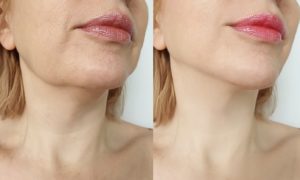 Cómo realizar las fotos de Antes y Después en medicina estética para atraer nuevos clientes