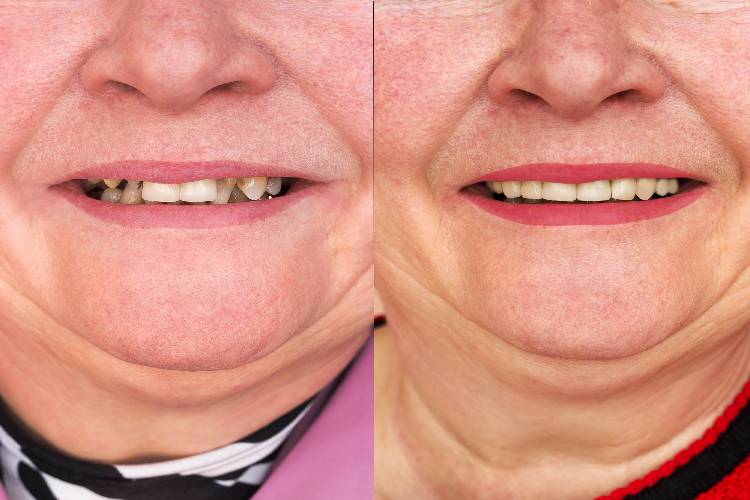 Cómo crear las mejores fotos de ‘Antes y Después’ para tu clínica odontológica